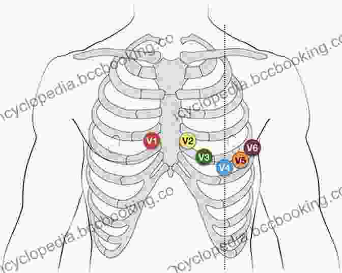 Diagram Depicting The Placement Of ECG Leads 12 Lead EKG For Nurses: Simple Steps To Interpret Rhythms Arrhythmias Blocks Hypertrophy Infarcts Cardiac Drugs